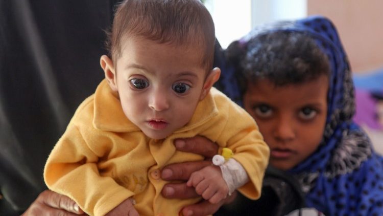 U Jemenu zbog pothranjenosti godišnje umre oko 30.000 djece mlađe od 5 godina