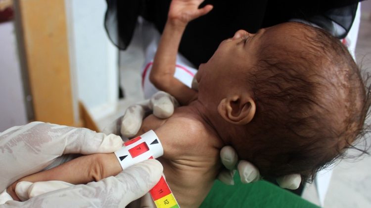 也门战争中饥饿的儿童