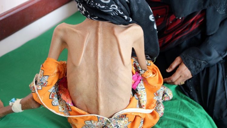 Fatima Ibrahim Hadi, 12 år og 10 kg, på klinikk i Hajjah i Yemen